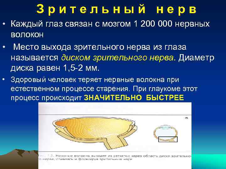 Атрофия диска зрительного нерва с  перегибом сосудов при глаукоме 