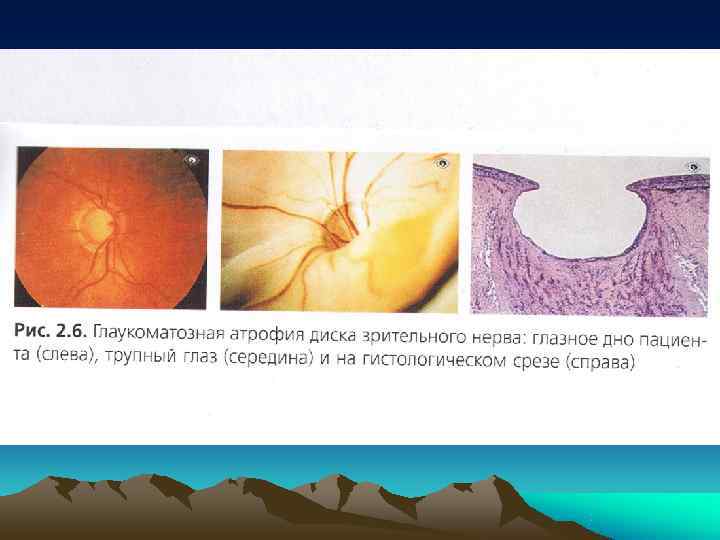  Открытоугольная глаукома  •  составляет 80% всей первичной  глаукомы  •