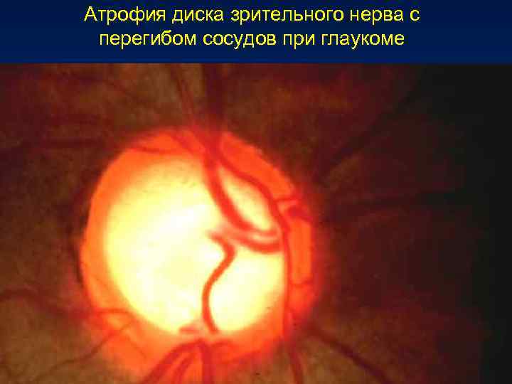    Стадии  глаукомы В основе деления лежат границы поля зрения 