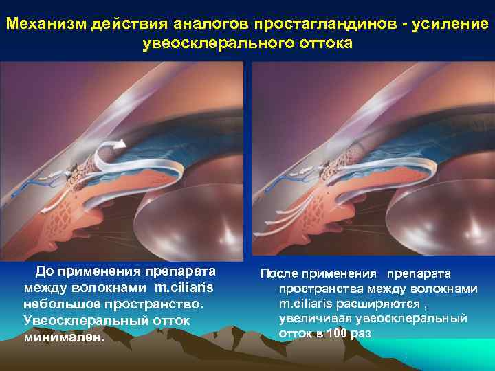 Отток жидкости. Увеосклеральный отток. Увеосклеральный путь оттока внутриглазной жидкости. Трабекулярный путь оттока водянистой влаги. Увеосклеральный путь оттока.