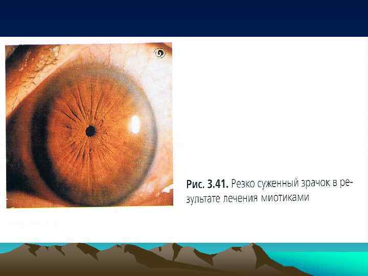       АЛЬФАГАН® P 0. 15%  препарат первого выбора