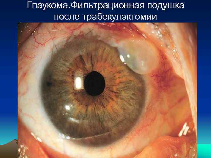    Биматопрост/тимолол  фиксированная комбинация - ГАНФОРТ  • ФКБТ (фиксированная комбинация