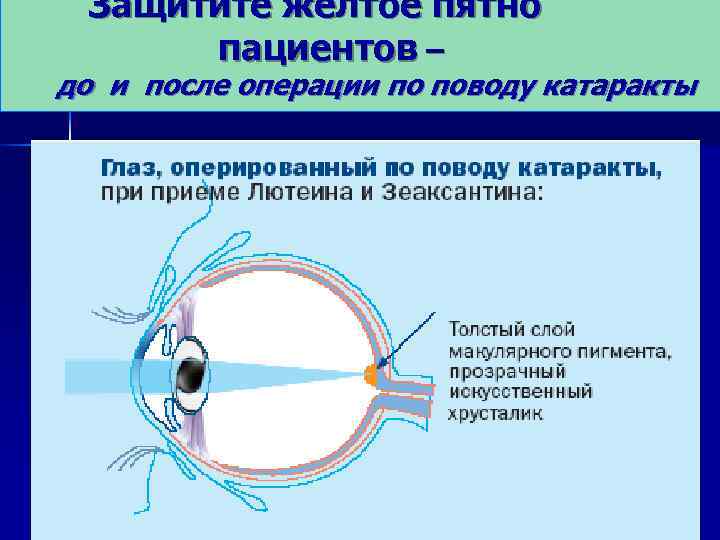  Защитите жёлтое пятно пациентов – до и после операции по поводу катаракты 
