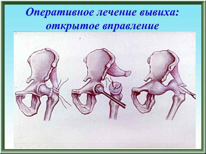 Схема врожденного вывиха бедра