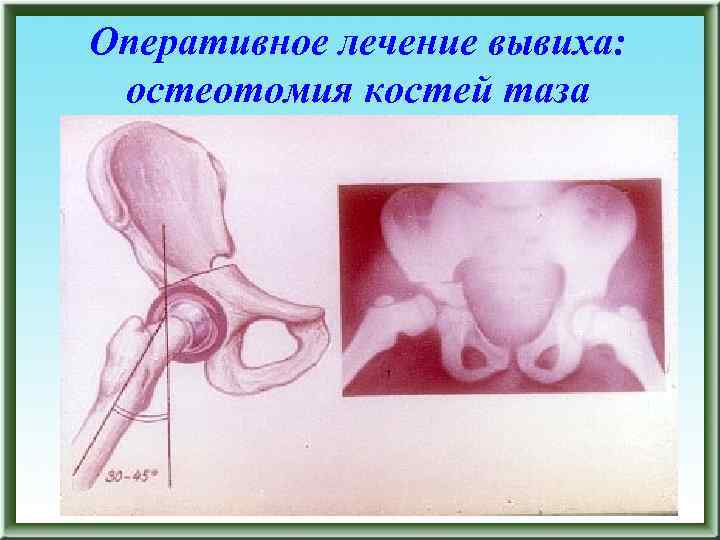 Оперативное лечение вывиха: остеотомия костей таза 