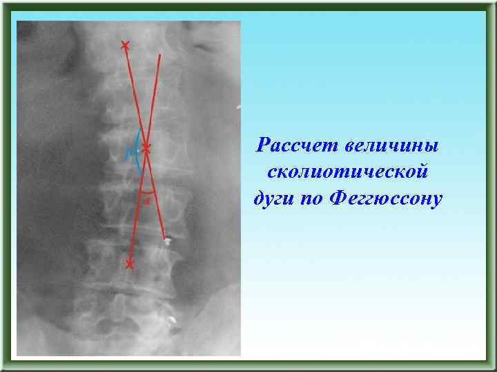 Рассчет величины сколиотической дуги по Феггюссону 