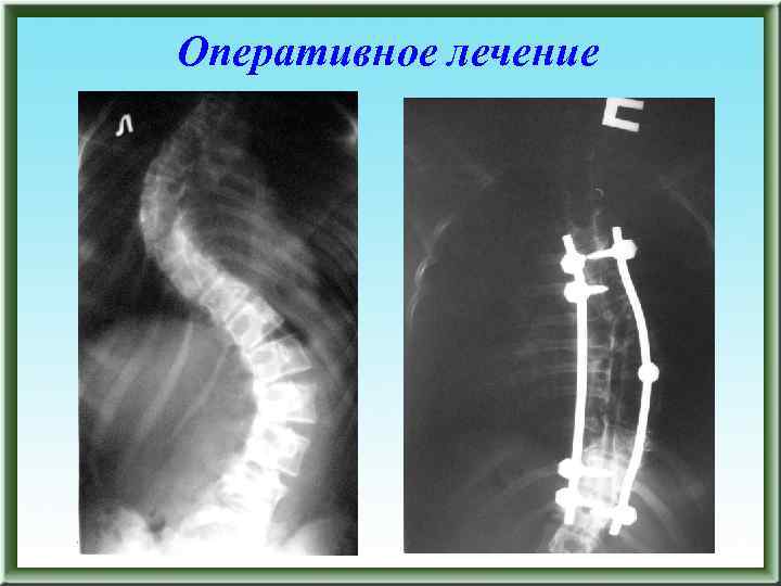 Оперативное лечение 