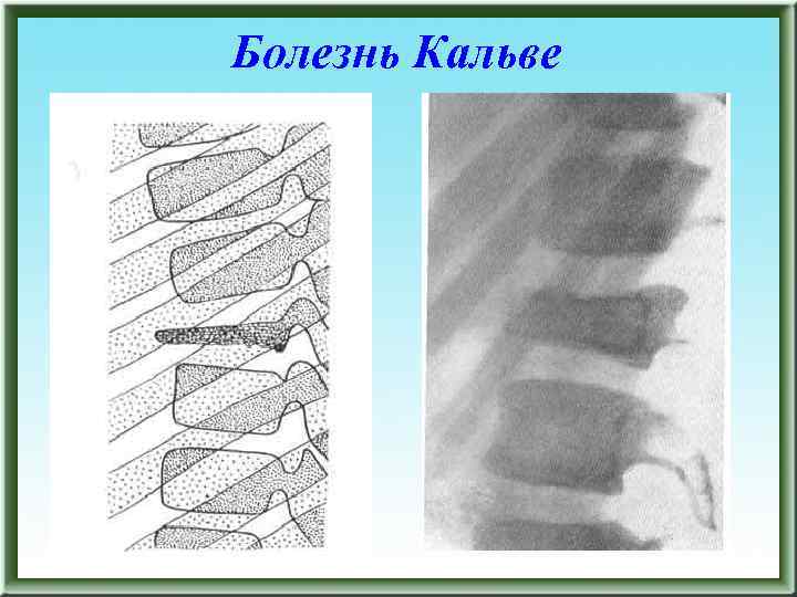 Болезнь Кальве 