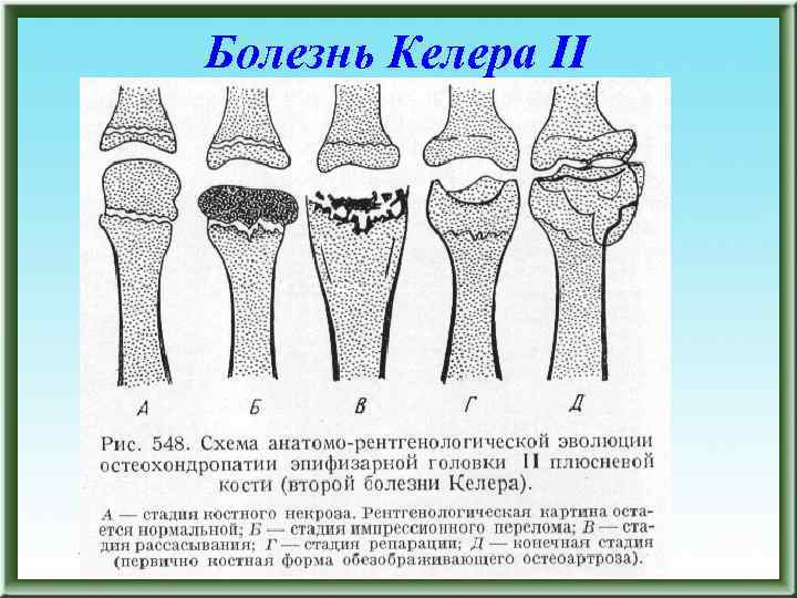 Болезнь Келера II 