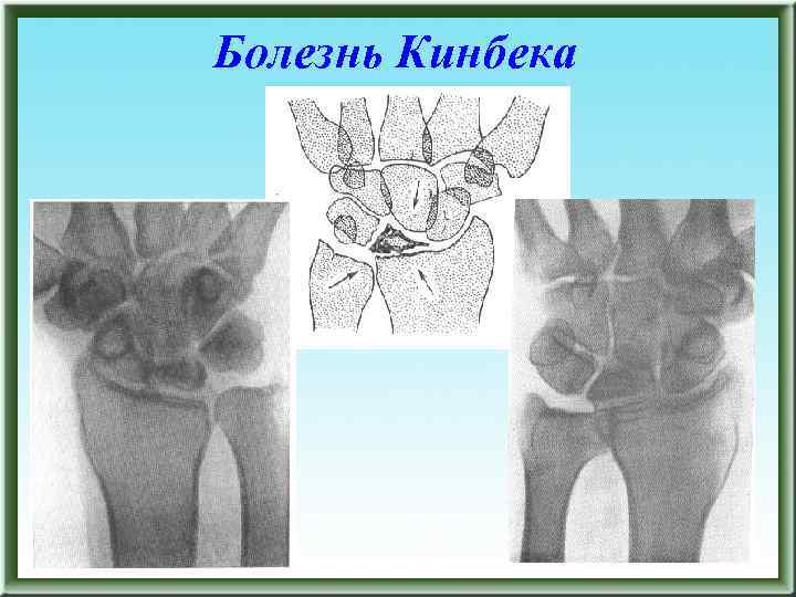 Болезнь кинбека презентация