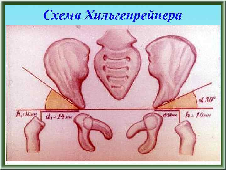 Схема хильгенрейнера тазобедренных суставов у детей