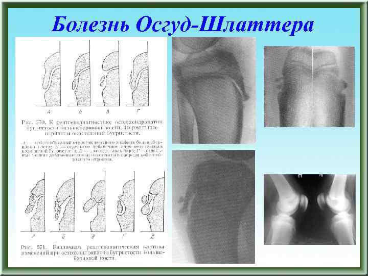 Врожденный вывих бедра презентация травматология