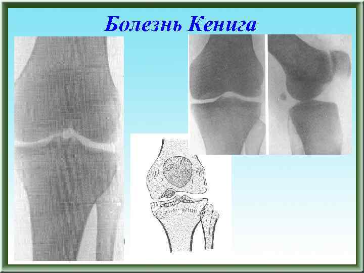 Болезнь кенига. Врожденный вывих бедра, кривошея,. Болезнь Кенига рентген описание.