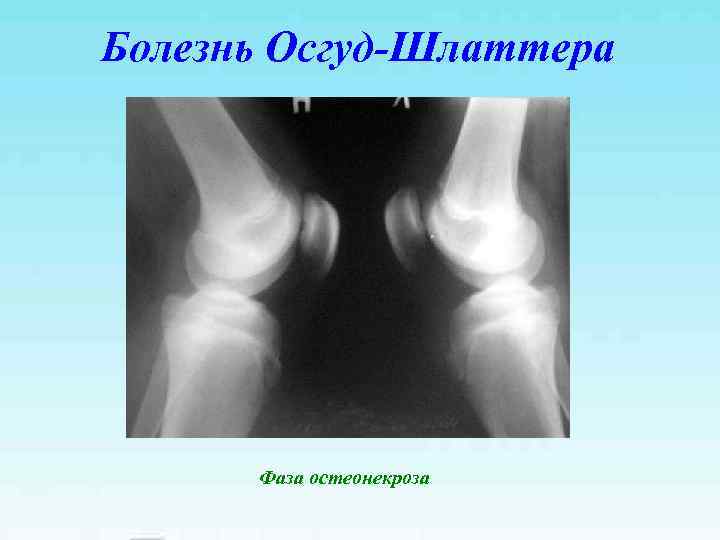 Болезнь Осгуд-Шлаттера Фаза остеонекроза 
