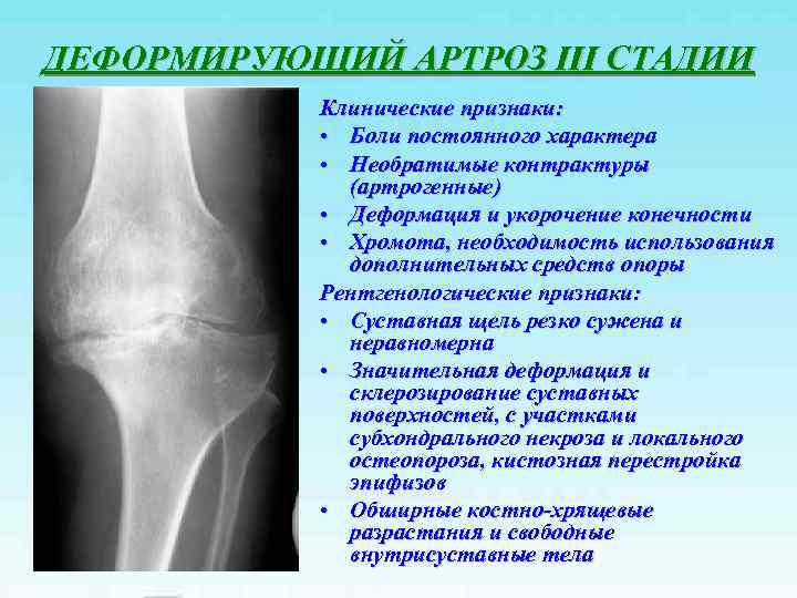 Диагноз доа суставов. Асептический некроз коленного сустава рентген. Деформирующий остеоартроз рентген. Рентген коленного сустава деформирующий гонартроз. Доа коленного сустава на рентгене.