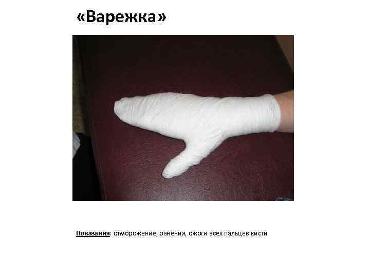  «Варежка» Показания: отморожение, ранения, ожоги всех пальцев кисти 
