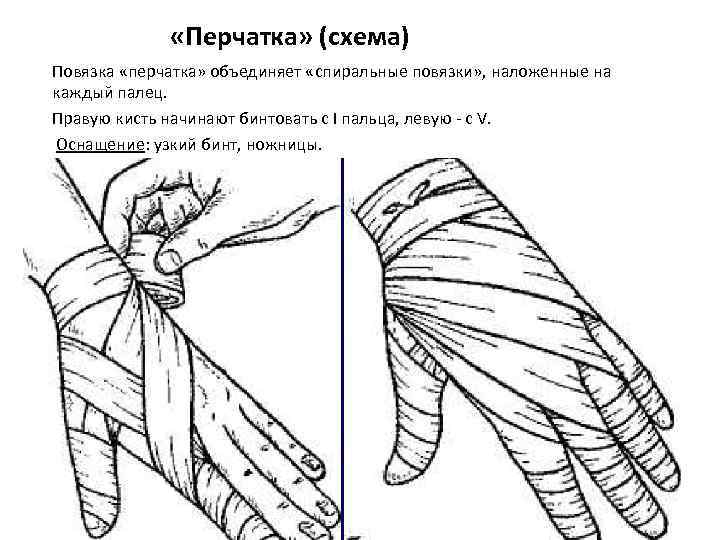 Бинтование перчатка схема