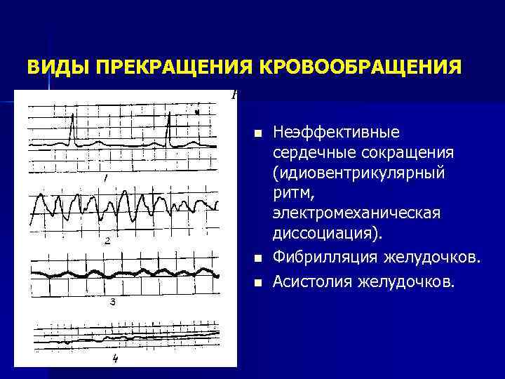 Признаки электромеханической диссоциации