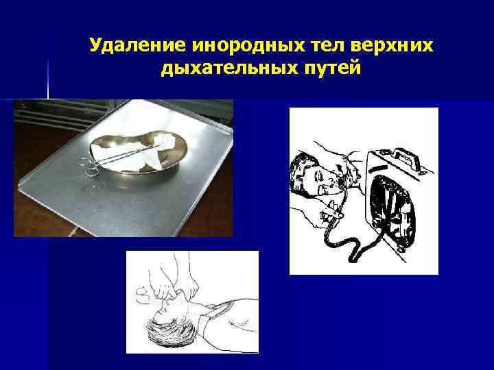 Удаление инородных тел верхних  дыхательных путей 