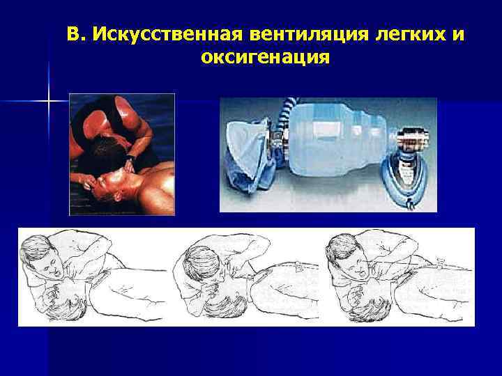 B. Искусственная вентиляция легких и   оксигенация 
