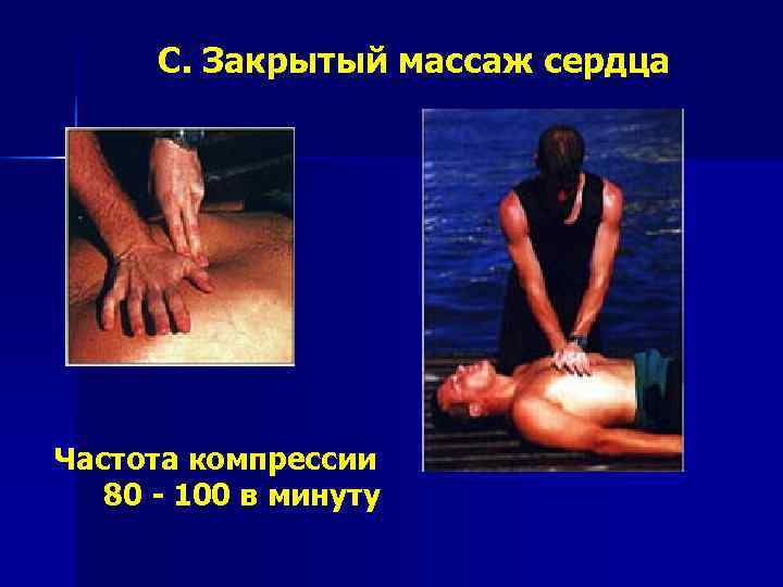  C. Закрытый массаж сердца Частота компрессии  80 - 100 в минуту 