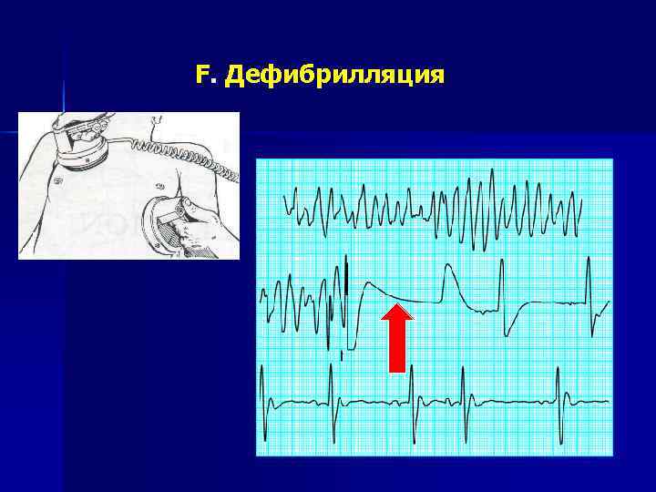 F. Дефибрилляция 