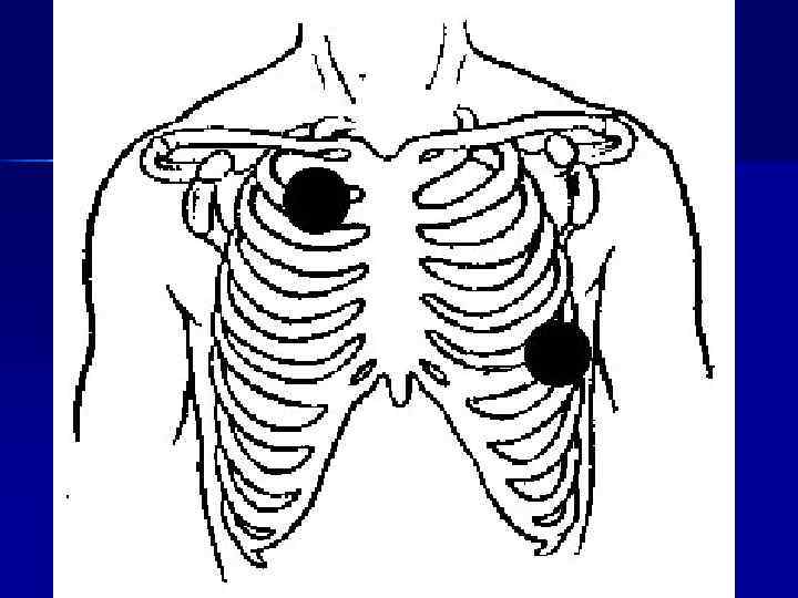       Фибрилляция желудочков или     желудочковая