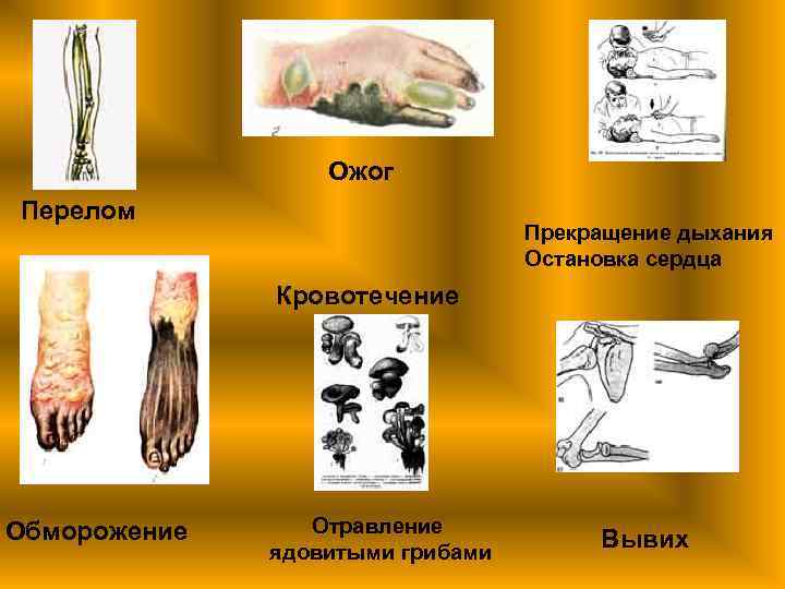  Ожог Перелом Прекращение дыхания Остановка сердца Кровотечение Обморожение Отравление ядовитыми грибами Вывих 