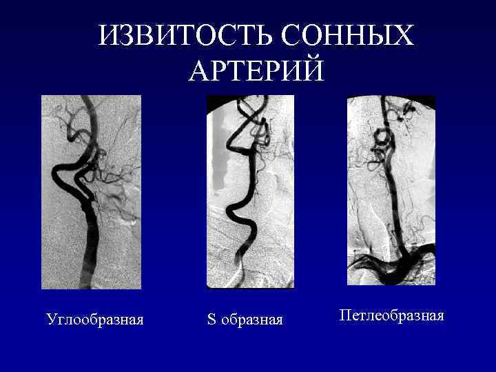 S артерии образная