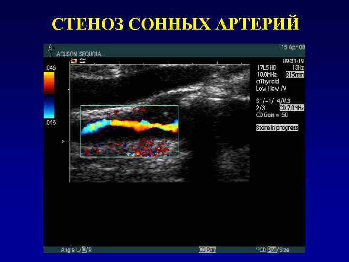 Стеноз сонной артерии. Окклюзия сонной артерии на УЗИ. Гемодинамически значимый стеноз сонной артерии УЗИ процент. Гемодинамически значимый стеноз сонной артерии. Стеноз сонных артерий на УЗИ.