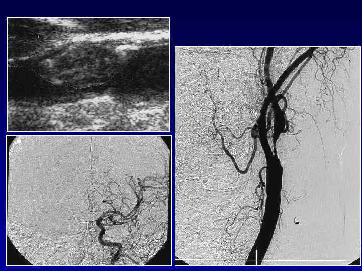 ХАРАКТЕР БЛЯШКИ В СОННОЙ АРТЕРИИ   Гетерогенные бляшки 