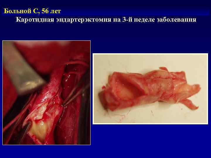  Клиническая картина кардиоэмболического инсульта • Внезапное начало • Быстрое появление и  нарастание