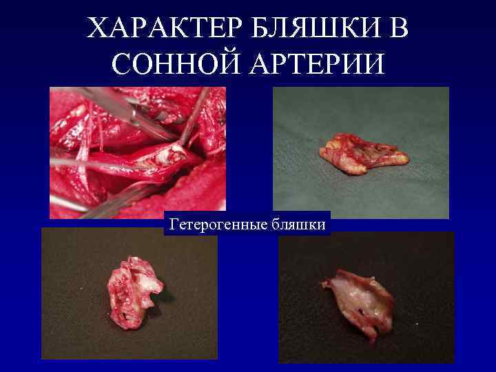    Источники кардиоэмболии l  Шунтирование из правых отделов сердца в левые