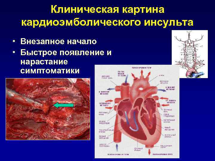   Мерцательная аритмия (МА)  Стаз крови в левом предсердии и его ушке