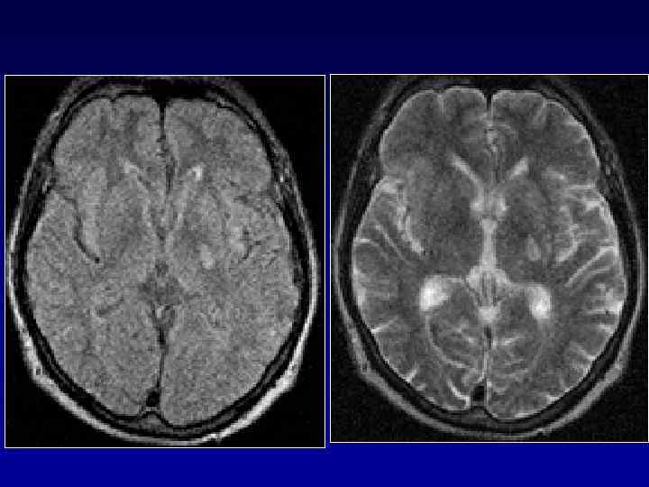  Причины диссекции артерии l  СПОНТАННАЯ: = наследственные дефекты коллагена = точковая мутация