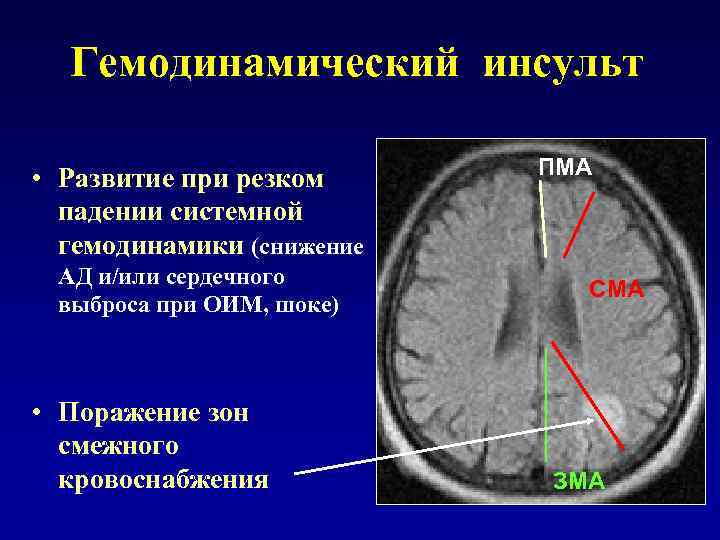 ИНСУЛЬТ НЕИЗВЕСТНОЙ ЭТИОЛОГИИ К этой категории относятся пациенты с двумя или более возможными причинами
