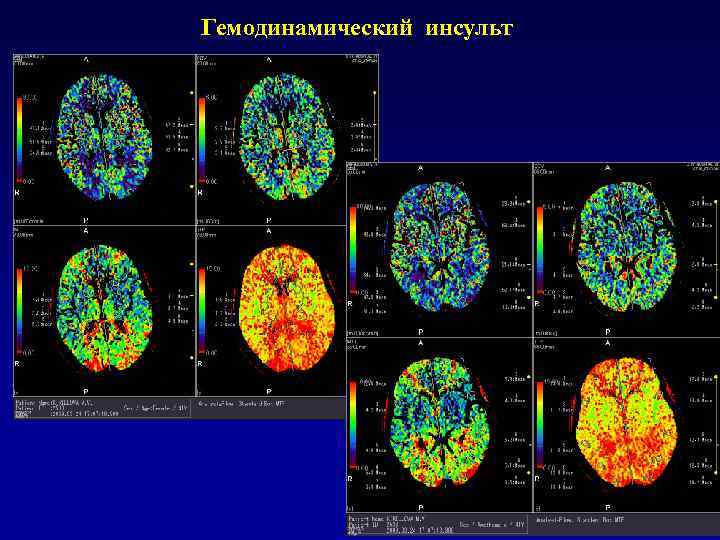 Диагностика инсульта. Гемодинамический ишемический инсульт. Гемодинамический и лакунарный ишемический инсульт. Гемодинамический Подтип ишемического инсульта. Гемодинамический инфаркт мозга.