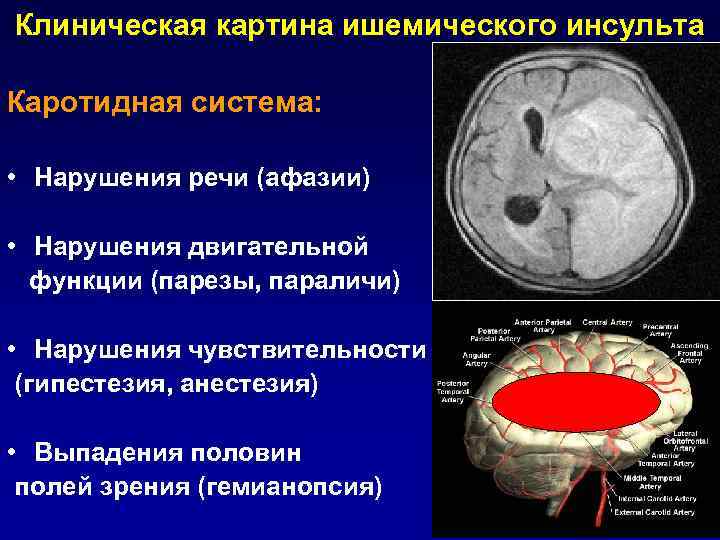 Правосторонний ишемический инсульт головного мозга. Клиника ишемического инсульта неврология. Ишемический инсульт в каротидном бассейне. Топический диагноз ишемического инсульта. Инсульт в каротидном бассейне.