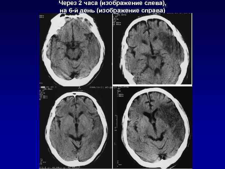   Ранние КТ-признаки инфаркта мозга  Гиперденсивность сосудов –  С-м гиперденсивной СМА