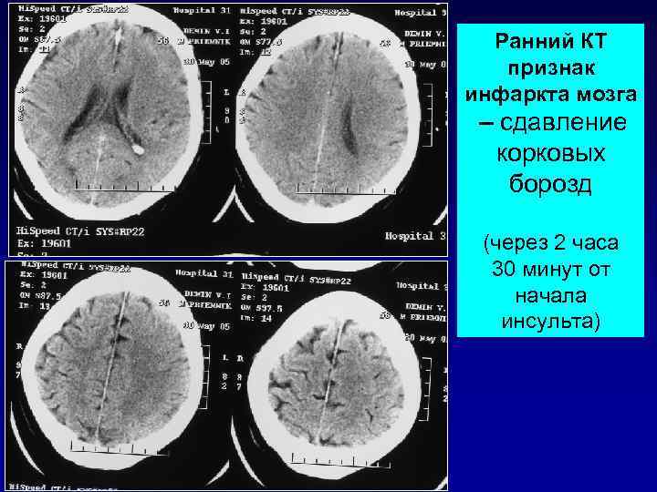      КТ головного мозга до ТЛТ    (1,