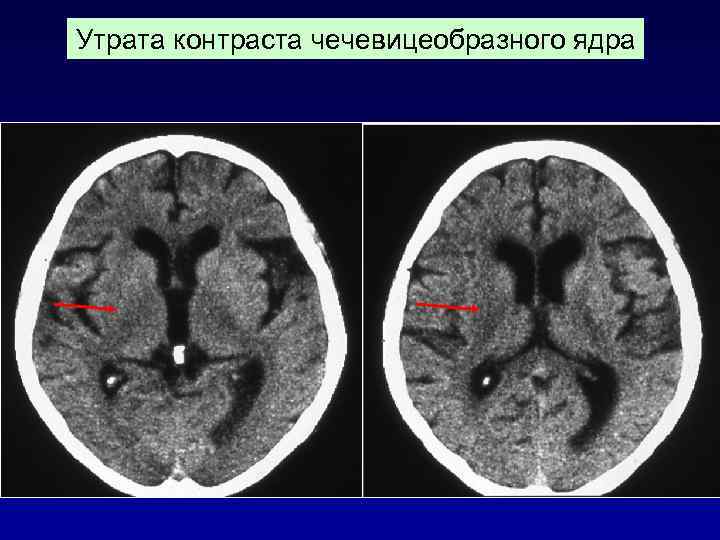  КТ перфузия (1, 8 часа от начала заболевания) CBF    