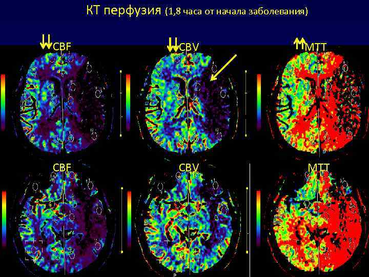 Диффузия и перфузия. Кт перфузия головного мозга нормы. Кт перфузия головного мозга при ишемическом. Кт перфузия головного мозга методика. Кт перфузия головного мозга при ишемическом инсульте.