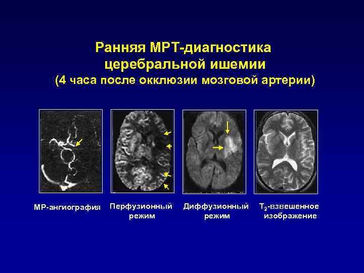 Инфаркт головного мозга 