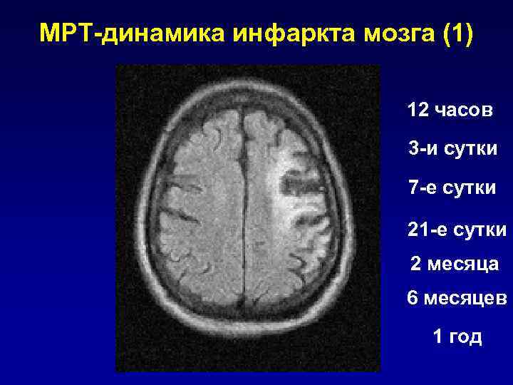   Диагностика ишемического    инсульта Инструментальная диагностика  •  Нейровизуализация