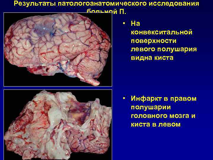    КТ-ангиография Окклюзия левой средней мозговой артерии 