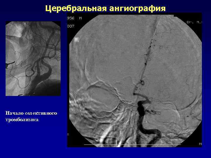 Дуплексное сканирование МАГ  Бляшка  Левая ВСА 