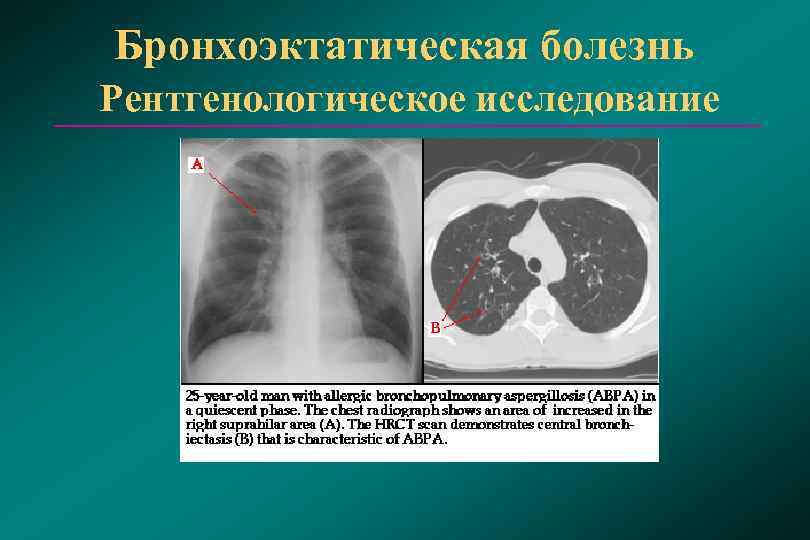 Бронхоэктатическая болезнь картинки