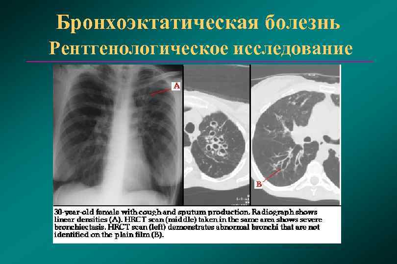 Бронхоэктазы нижней доли