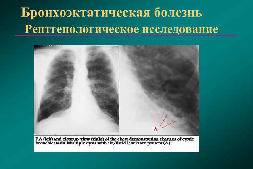 Бронхоэктатическая болезнь картинки