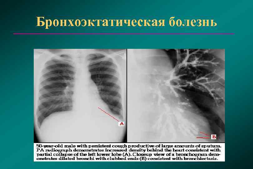 Рентген картина бронхоэктазов